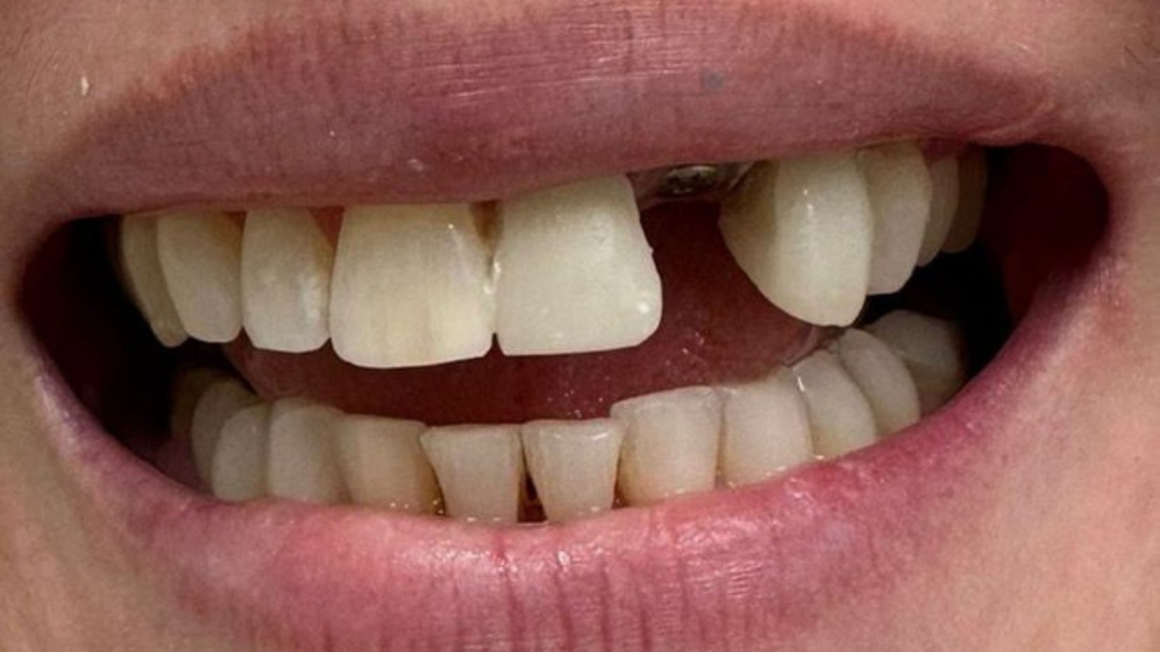 Lost dental crown repair LA