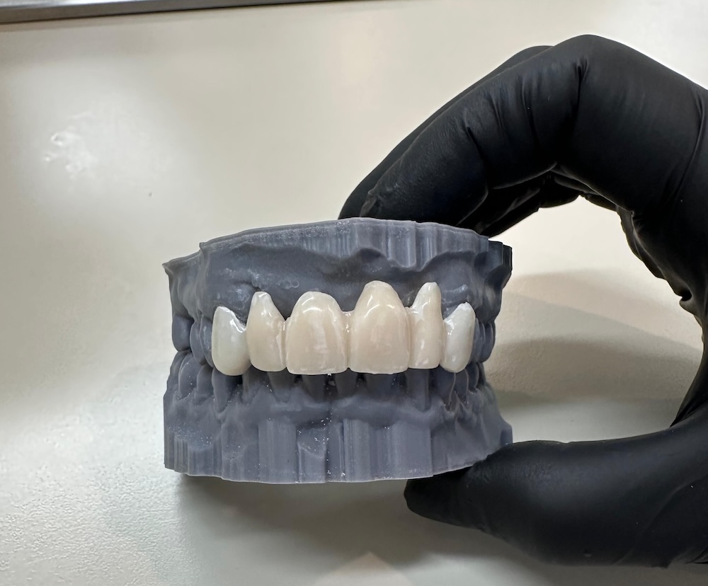 Same-day 3D printed restorations LA