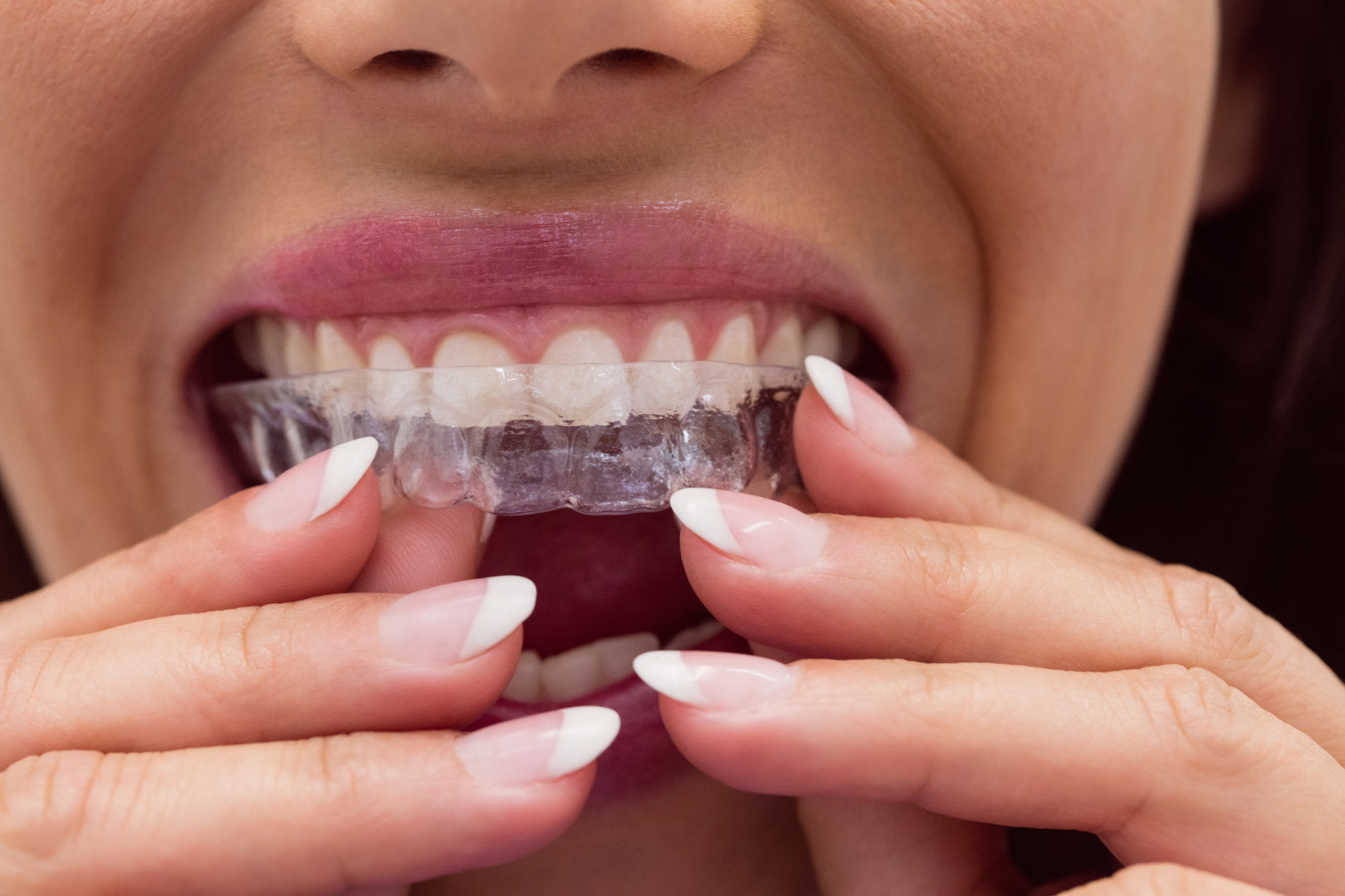 Night Guards for Teeth Grinding